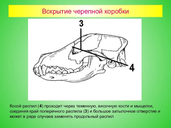 Вскрытие черепной коробки Косой распил (4) проходит через теменную, височную кости и