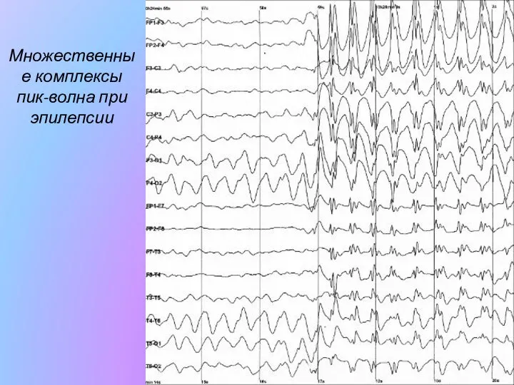 Множественные комплексы пик-волна при эпилепсии