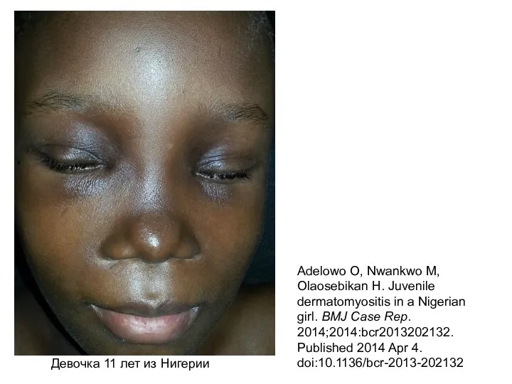 Adelowo O, Nwankwo M, Olaosebikan H. Juvenile dermatomyositis in a Nigerian girl.