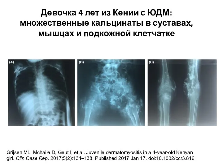 Девочка 4 лет из Кении с ЮДМ: множественные кальцинаты в суставах, мышцах