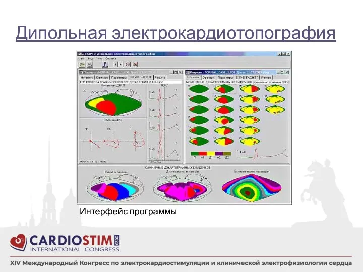 Дипольная электрокардиотопография Интерфейс программы