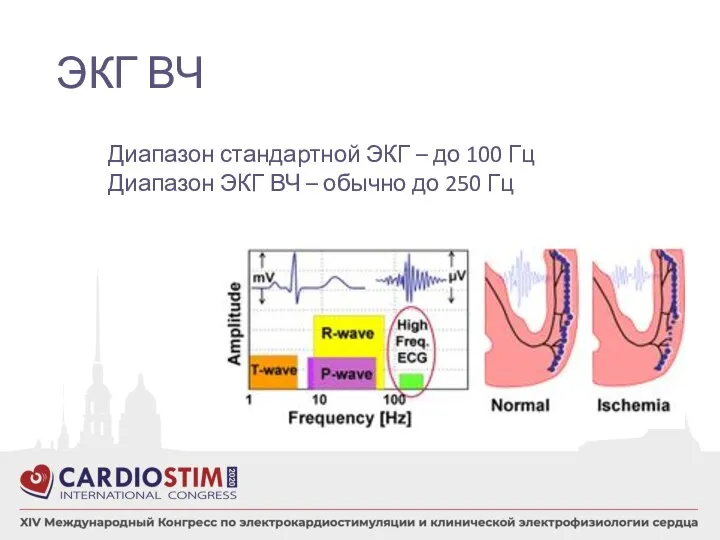 ЭКГ ВЧ Диапазон стандартной ЭКГ – до 100 Гц Диапазон ЭКГ ВЧ