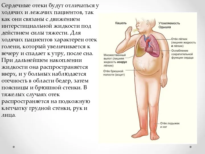 Сердечные отеки будут отличаться у ходячих и лежачих пациентов, так как они