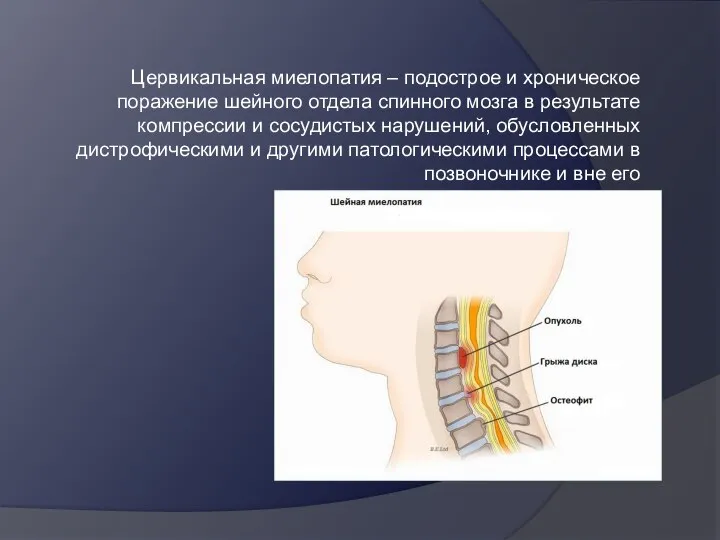 Цервикальная миелопатия – подострое и хроническое поражение шейного отдела спинного мозга в