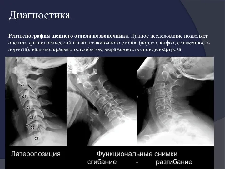 Диагностика Рентгенография шейного отдела позвоночника. Данное исследование позволяет оценить физиологический изгиб позвоночного