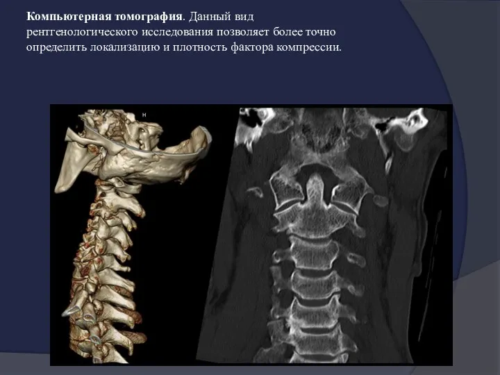 Компьютерная томография. Данный вид рентгенологического исследования позволяет более точно определить локализацию и плотность фактора компрессии.