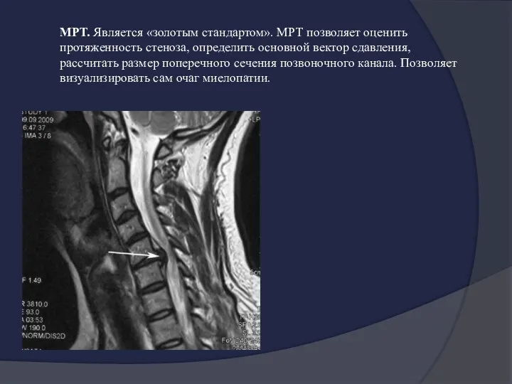 МРТ. Является «золотым стандартом». МРТ позволяет оценить протяженность стеноза, определить основной вектор