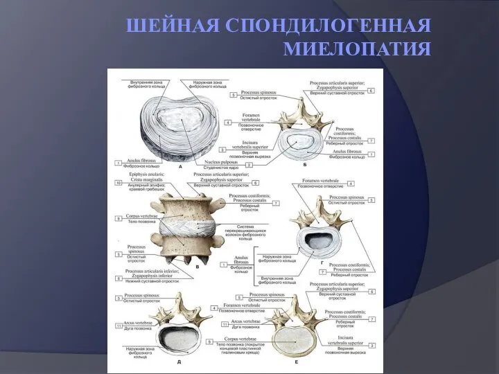 ШЕЙНАЯ СПОНДИЛОГЕННАЯ МИЕЛОПАТИЯ