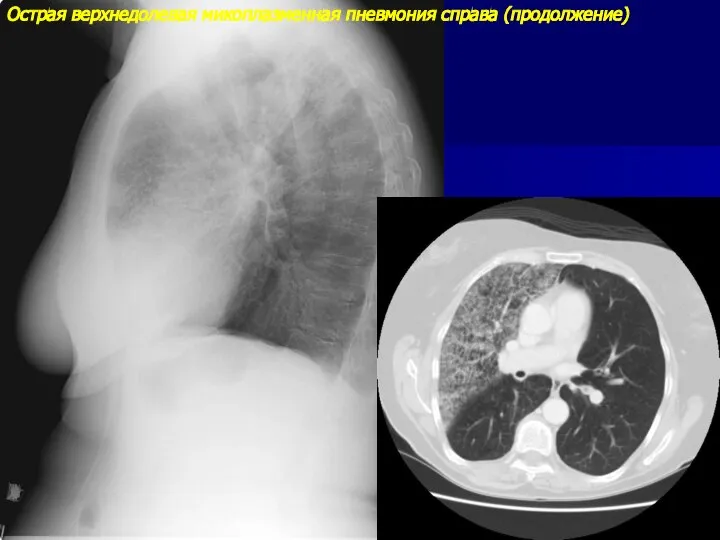 Острая верхнедолевая микоплазменная пневмония справа (продолжение)