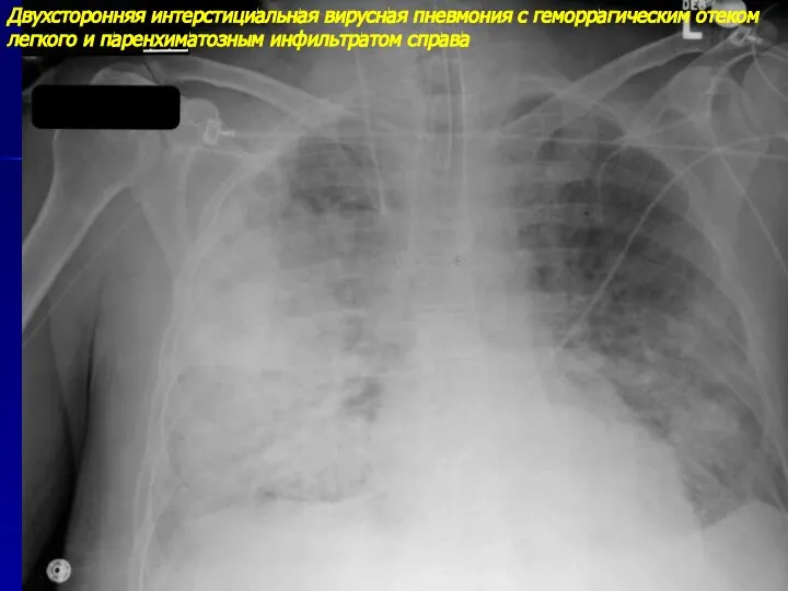 Двухсторонняя интерстициальная вирусная пневмония с геморрагическим отеком легкого и паренхиматозным инфильтратом справа