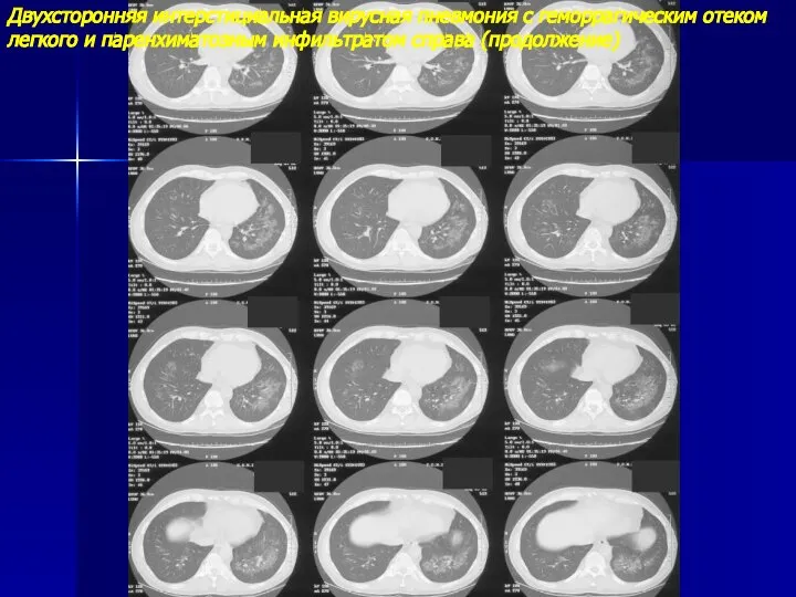 Двухсторонняя интерстициальная вирусная пневмония с геморрагическим отеком легкого и паренхиматозным инфильтратом справа (продолжение)