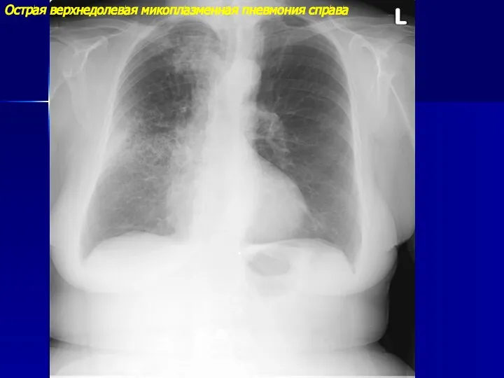 Острая верхнедолевая микоплазменная пневмония справа