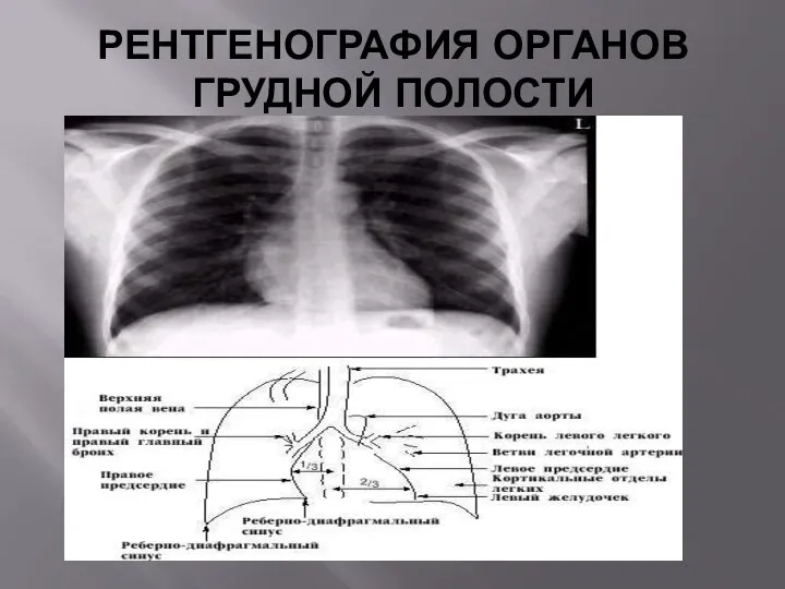 РЕНТГЕНОГРАФИЯ ОРГАНОВ ГРУДНОЙ ПОЛОСТИ