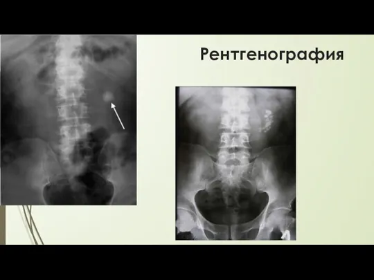 Рентгенография