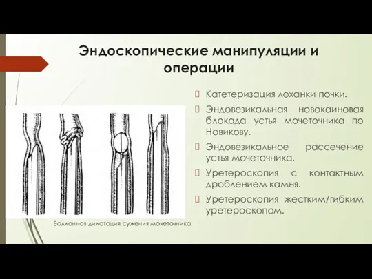 Эндоскопические манипуляции и операции Катетеризация лоханки почки. Эндовезикальная новокаиновая блокада устья мочеточника