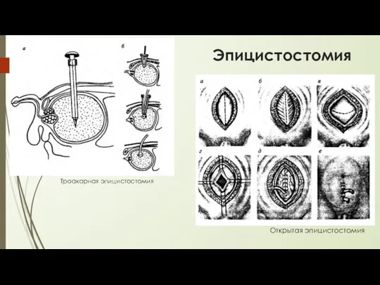 Эпицистостомия Троакарная эпицистостомия Открытая эпицистостомия