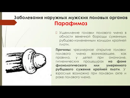 Заболевания наружных мужских половых органов Парафимоз Ущемление головки полового члена в области