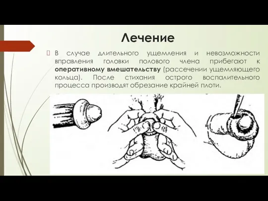 Лечение В случае длительного ущемления и невозможности вправления головки полового члена прибегают