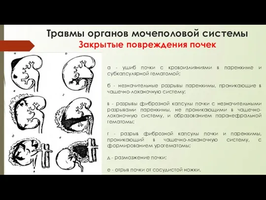 Травмы органов мочеполовой системы Закрытые повреждения почек а - ушиб почки с