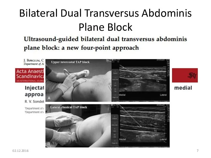 Bilateral Dual Transversus Abdominis Plane Block 02.12.2016