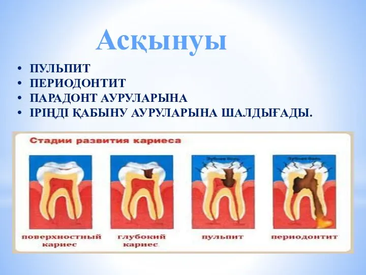 ПУЛЬПИТ ПЕРИОДОНТИТ ПАРАДОНТ АУРУЛАРЫНА ІРІҢДІ ҚАБЫНУ АУРУЛАРЫНА ШАЛДЫҒАДЫ. Асқынуы