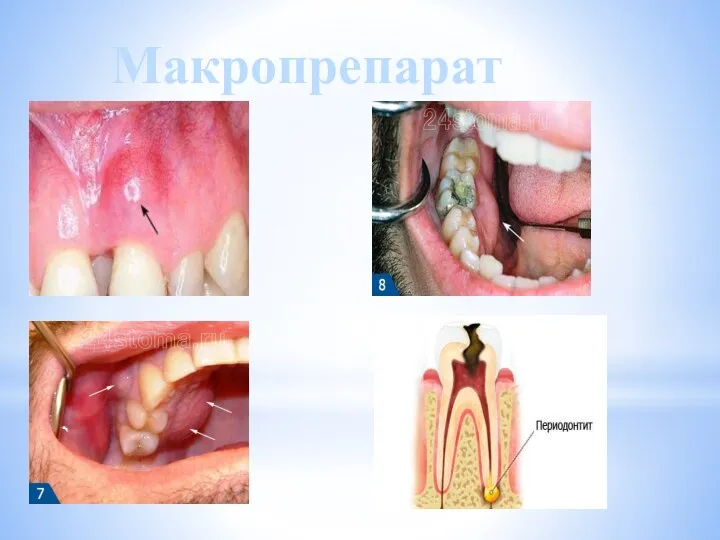 Макропрепарат