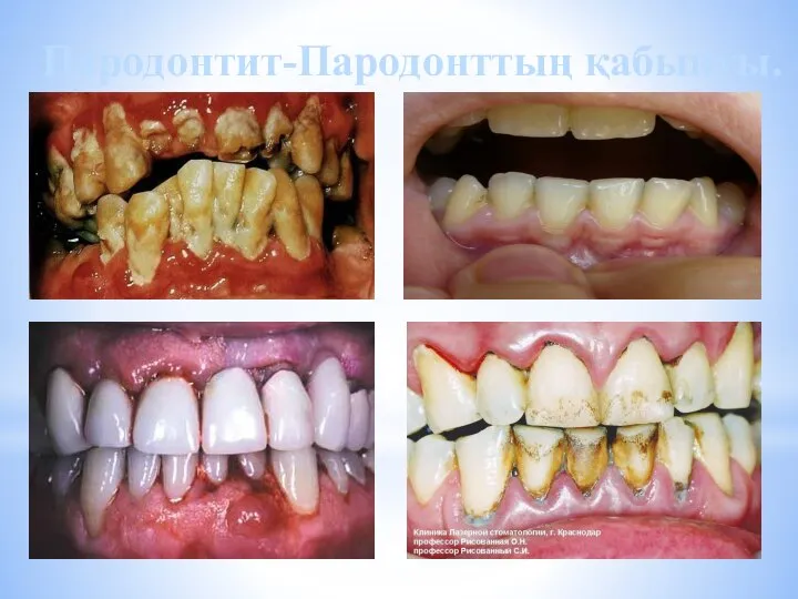 Пародонтит-Пародонттың қабынуы.