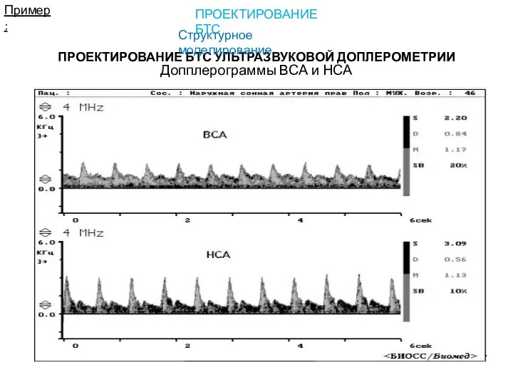 Допплерограммы ВСА и НСА Пример: ПРОЕКТИРОВАНИЕ БТС УЛЬТРАЗВУКОВОЙ ДОПЛЕРОМЕТРИИ