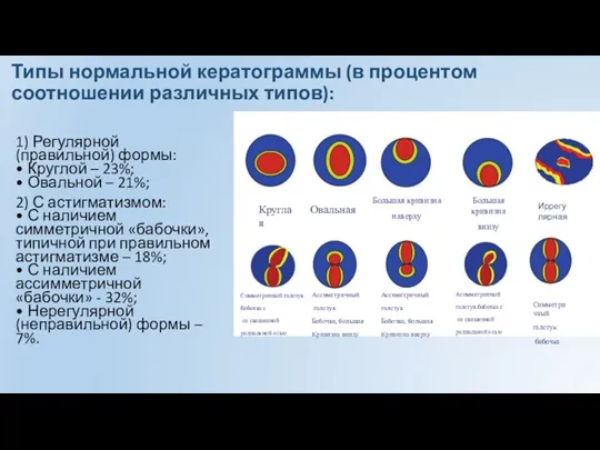 Типы нормальной кератограммы (в процентом соотношении различных типов): 1) Регулярной (правильной) формы: