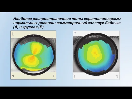 Наиболее распространенные типы кератотопограмм нормальных роговиц: симметричный галстук-бабочка (А) и круглая (Б).