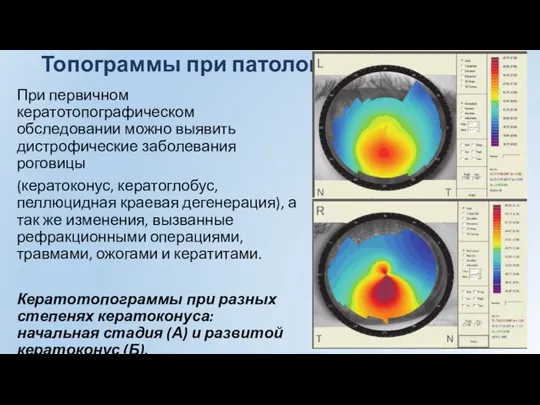 Топограммы при патологии. При первичном кератотопографическом обследовании можно выявить дистрофические заболевания роговицы