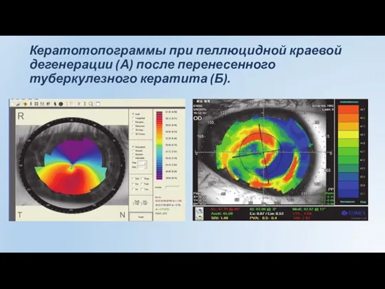 Кератотопограммы при пеллюцидной краевой дегенерации (А) после перенесенного туберкулезного кератита (Б).