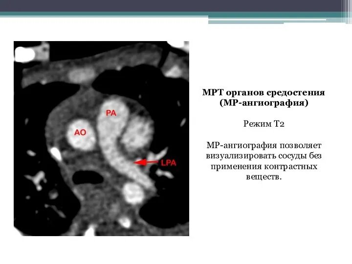 МРТ органов средостения (МР-ангиография) Режим Т2 МР-ангиография позволяет визуализировать сосуды без применения контрастных веществ.