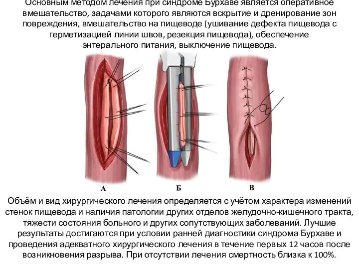 Основным методом лечения при синдроме Бурхаве является оперативное вмешательство, задачами которого являются