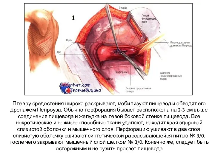 Плевру средостения широко раскрывают, мобилизуют пищевод и обводят его дренажем Пенроуза. Обычно