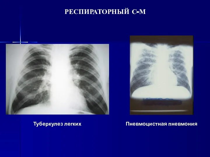 РЕСПИРАТОРНЫЙ С-М Туберкулез легких Пневмоцистная пневмония