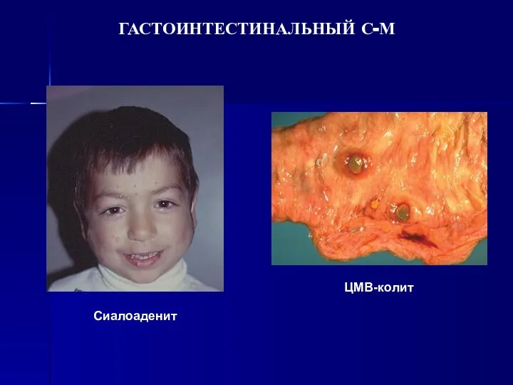 ГАСТОИНТЕСТИНАЛЬНЫЙ С-М ЦМВ-колит Сиалоаденит