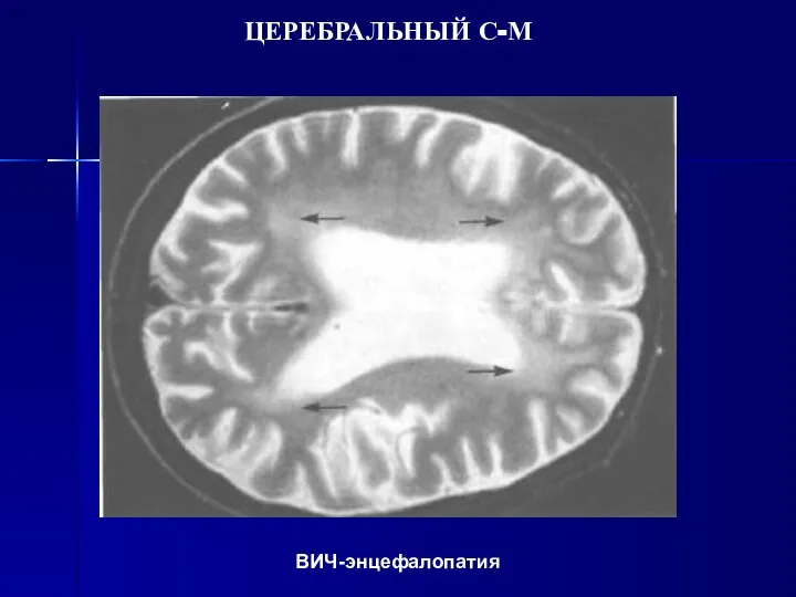 ЦЕРЕБРАЛЬНЫЙ С-М ВИЧ-энцефалопатия