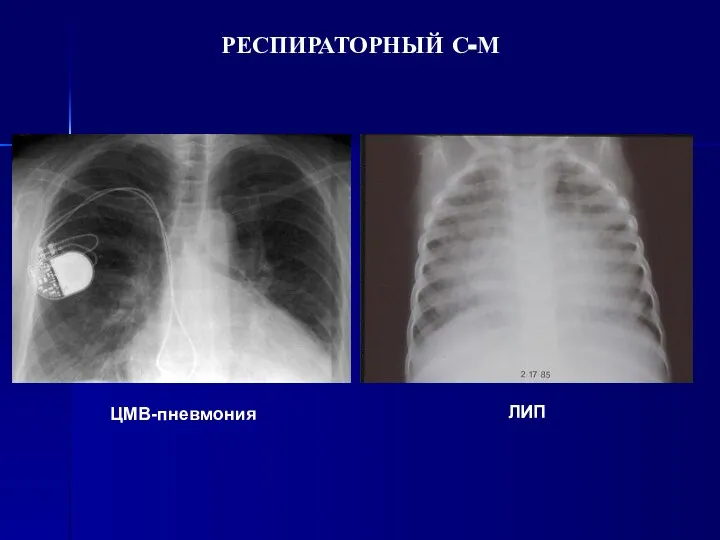 РЕСПИРАТОРНЫЙ С-М ЦМВ-пневмония ЛИП