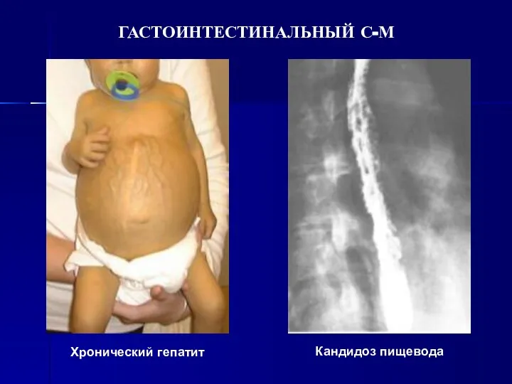 ГАСТОИНТЕСТИНАЛЬНЫЙ С-М Хронический гепатит Кандидоз пищевода
