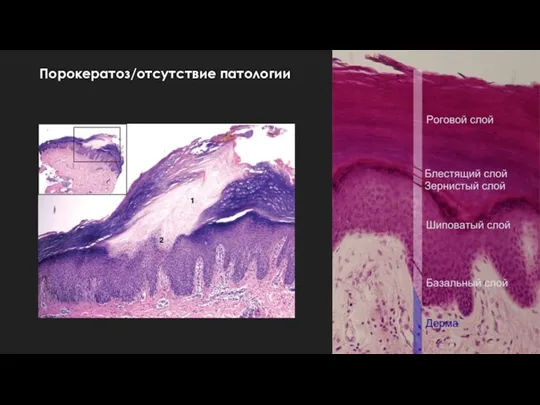Порокератоз/отсутствие патологии