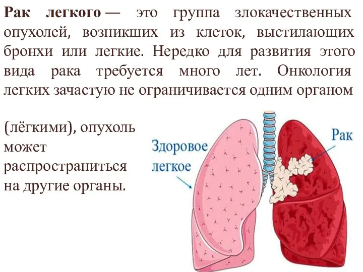 Рак легкого — это группа злокачественных опухолей, возникших из клеток, выстилающих бронхи