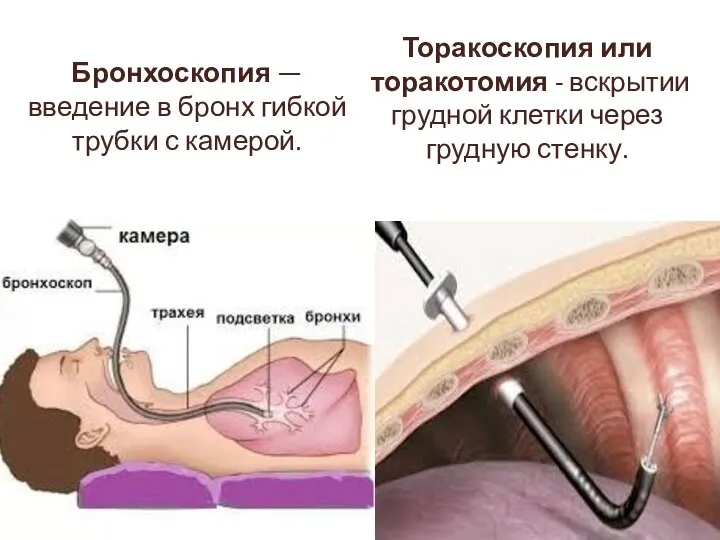 Бронхоскопия — введение в бронх гибкой трубки с камерой. Торакоскопия или торакотомия