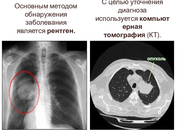 Основным методом обнаружения заболевания является рентген. С целью уточнения диагноза используется компьютерная томография (КТ).