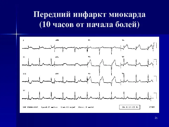 Передний инфаркт миокарда (10 часов от начала болей)