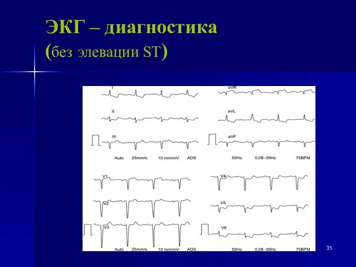 ЭКГ – диагностика (без элевации ST)