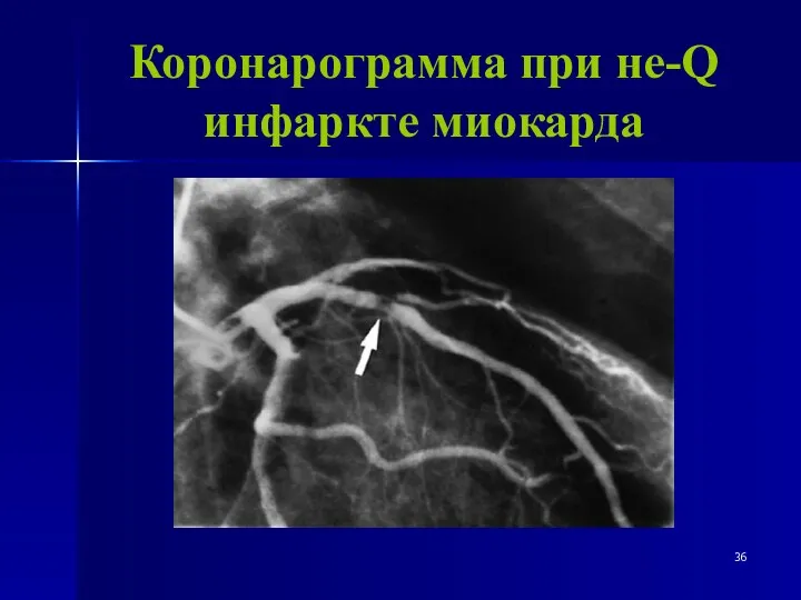 Коронарограмма при не-Q инфаркте миокарда