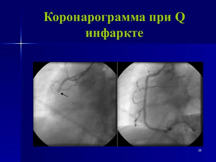 Коронарограмма при Q инфаркте