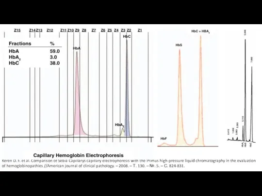 Keren D. F. et al. Comparison of Sebia Capillarys capillary electrophoresis with