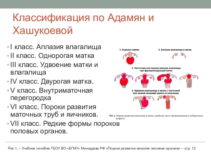 Классификация по Адамян и Хашукоевой I класс. Аплазия влагалища II класс. Однорогая